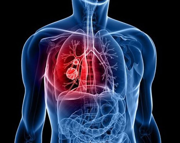 Паразити в белите дробове